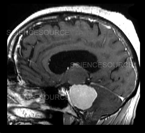 Photograph | MRI Large Acoustic Schwannoma (Vestibu | Science Source Images