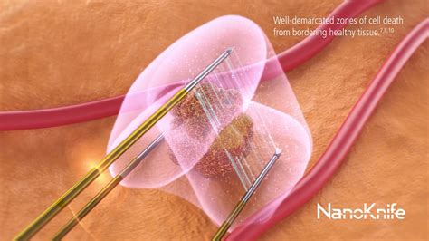 NanoKnife System Ablation Animation - YouTube