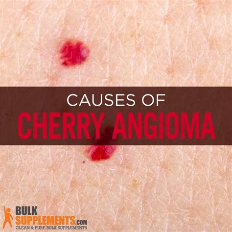 Cherry Angioma: Characteristics, Causes & Treatment