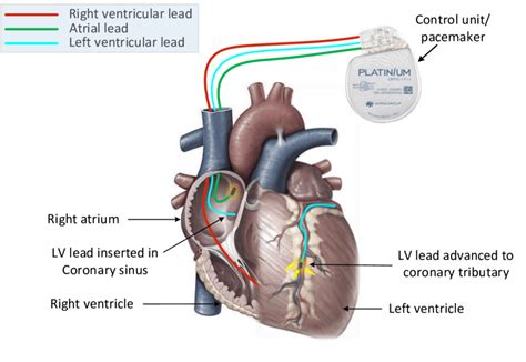 In CRT or Biventricular pacemaker, a left ventricular lead is implanted... | Download Scientific ...