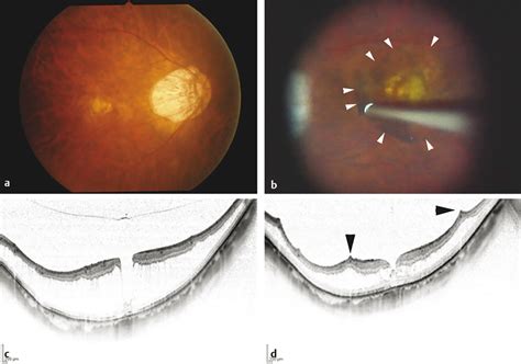 Myopic Degeneration and Myopic Foveoschisis | Ento Key