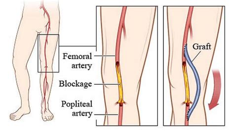 Lower Limb Bypass Surgery | Vascular & Endovascular