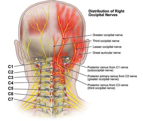 Found on Google from completepaincare.com | Occipital neuralgia, Neuralgia, Occipital nerve block