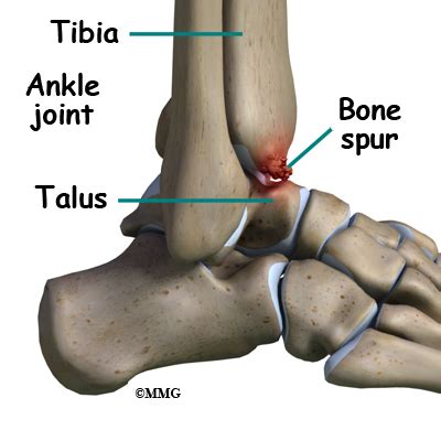 A Patient’s Guide to Ankle Arthroscopy | Houston Methodist