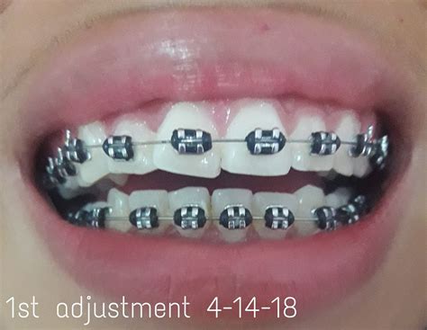 Black Braces: My 2nd Color of Bands