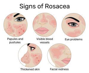 Psoriasis Vs Eczema: Let's Understand The Difference