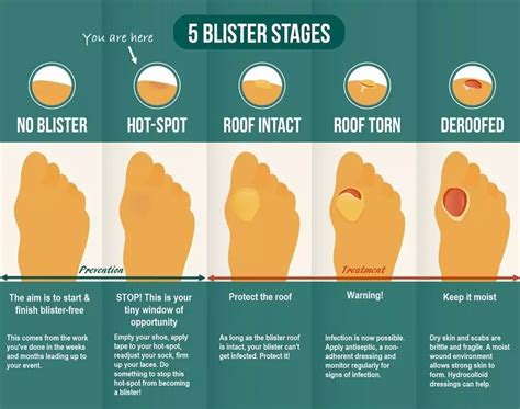 How To Treat Blisters on Feet: During and After Hiking and Walking