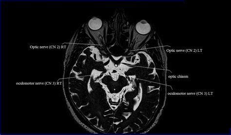 cranial nerves anatomy | MRI axial cranial nerves anatomy | free cross ...