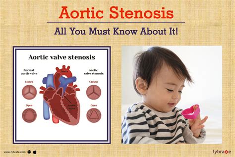 Aortic Stenosis - All You Must Know About It! - By Dr. Gaurav Agrawal (Pediatric Cardiologist ...