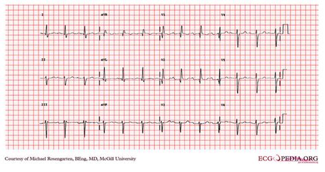 Trifascicular block - wikidoc