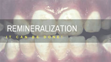 Picture Proof to show you can Remineralize teeth naturally | Mouth Ninja