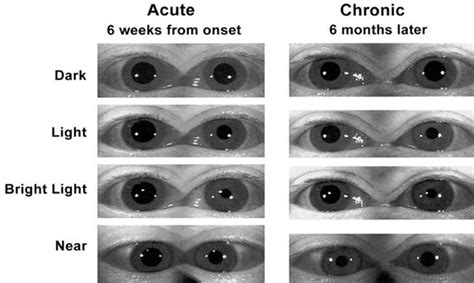 Approach to the Patient with Abnormal Pupils - Practical Neurology, 4th Ed.