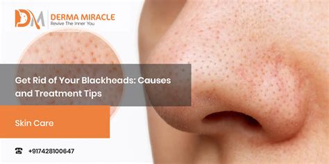 How To get Rid Of Blackheads Tips, Causes & Treatments.