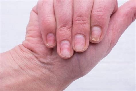 Solutions maison pour se débarrasser de l'aspect "ongles jaunes" - Améliore ta Santé