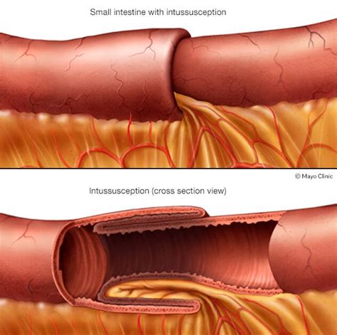 Intussusception - Symptoms & causes - Mayo Clinic