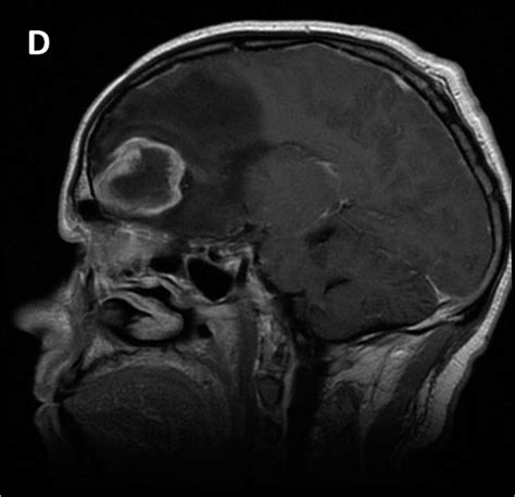 Surgical Neurology International