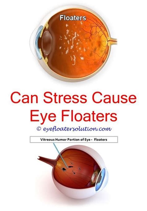 black floaters in eyes causes - can floaters be removed from your eyes.what cuases eye floaters ...