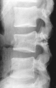 Chance Fracture (flexion-distraction injury) - Spine - Orthobullets