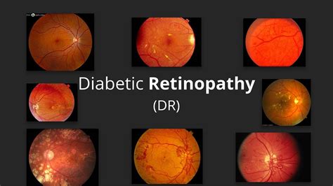 Diabetic Retinopathy (DR) – Pathophysiology, Stages, Screening, Prevention & Management of DR ...