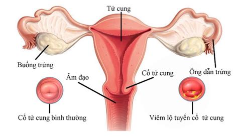 Viêm lộ tuyến cổ tử cung 0.5 cm nên làm gì? Điều trị thế nào