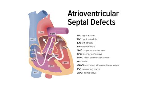 Defecto del Septo Auriculoventricular | Concise Medical Knowledge