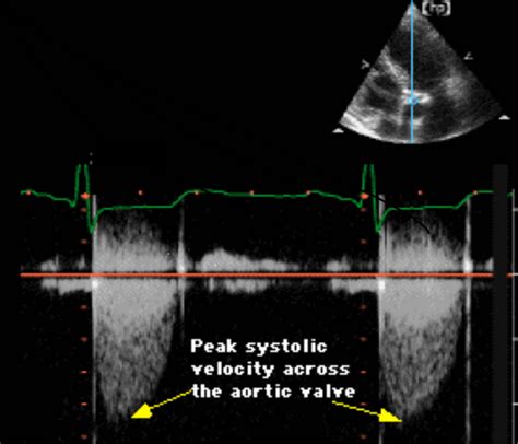 Aortic stenosis echocardiography - wikidoc