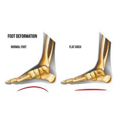 Supinated foot arch deformation bottom view Vector Image