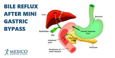 Bile Reflux After Mini Gastric Bypass Surgery - Mexico Bariatric Center®