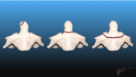 Anderson D’Alonzo Classification of Odontoid Fractures | UW Emergency ...