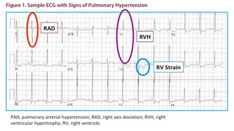 PAH.TV - Education and Resources > Resource Center > Testing & Diagnostics > Electrocardiogram