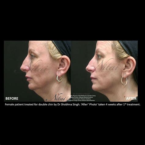 Double Chin Reduction Melbourne | Chin Fat Dissolving Injections at Nitai