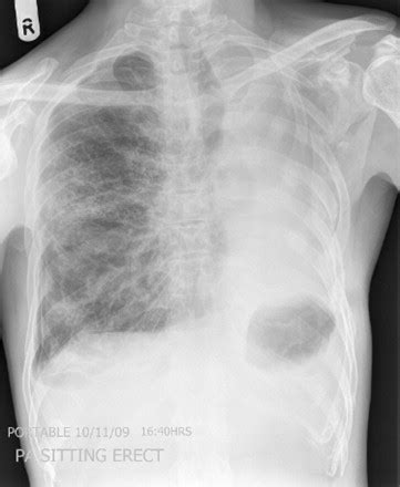 Spontaneous Pneumothorax After Traumatic Pneumonectomy: A Role for Talc ...