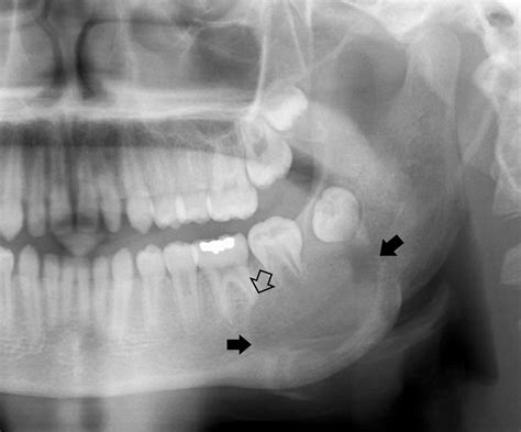 Ameloblastoma X Ray