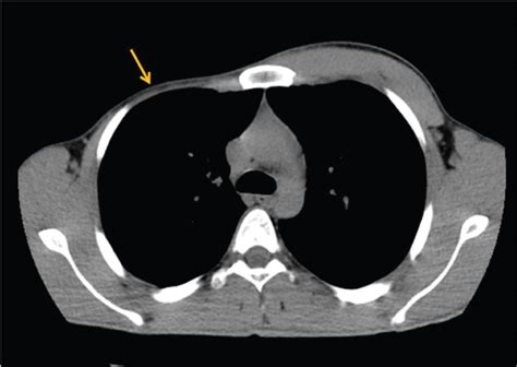 Poland Syndrome - Chest Wall Asymmetry - MEDizzy Journal