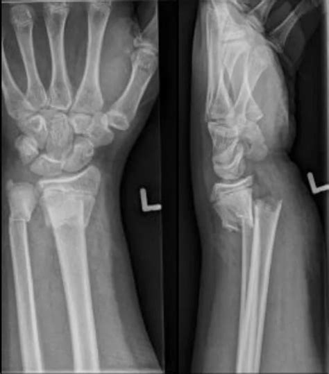 Colle Fracture - Distal Radial Fracture | Radiology Case | - RadioGyan