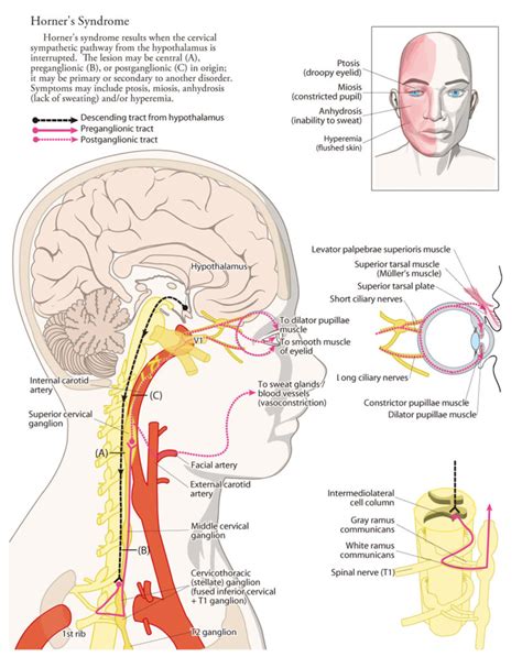 Horner's Syndrome - Causes, Signs & Symptoms, Diagnosis, Treatment