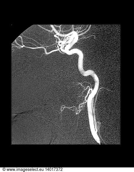 Internal Carotid Artery Internal Carotid Artery, Angiogram,angiography,arterial angiogram ...