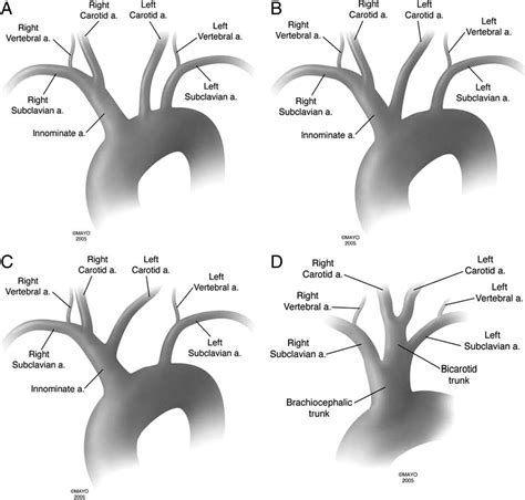 Figure 1. Bovine Arch and Other Aortic Arch Variations