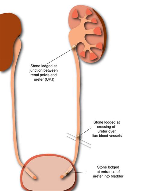 What causes kidney stone pain? -Symptoms- KidneyStoners.org