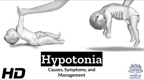 Hypotonia Explained: What You Need to Know - YouTube