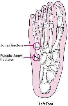 Pseudo Jones Fracture