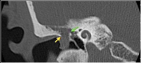 The Radiology Assistant : Temporal bone - Anatomy 2.0