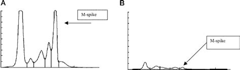 Protein electrophoresis of serum (A) and urine (B). (A),... | Download ...