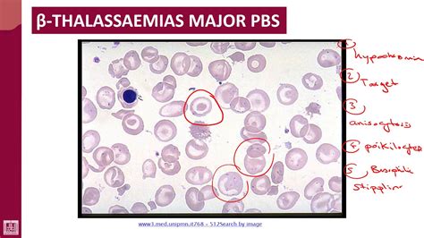 Hematology - 2 | U1-L35 | PBS of beta thalassemia major - YouTube