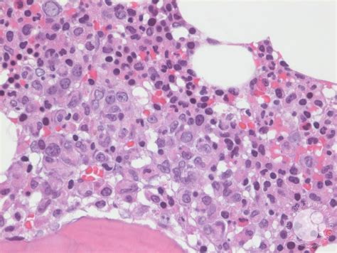 Multiple Myeloma, Bone Marrow Core