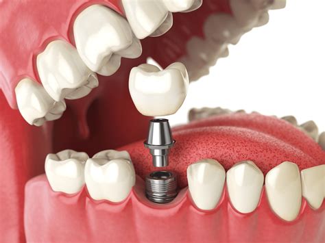 Everything You Need To Know About Dental Implants - Regency Square Dental