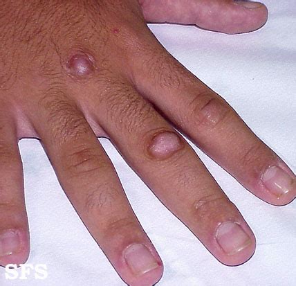 Knuckle Pain on Hand (Bones and Joints) Causes and Treatment | Healthhype.com