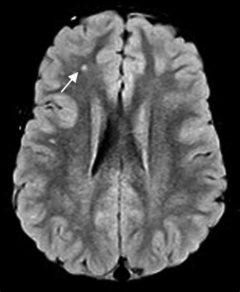 MRI white matter lesions in pediatric migraine - Tal Eidlitz-Markus ...