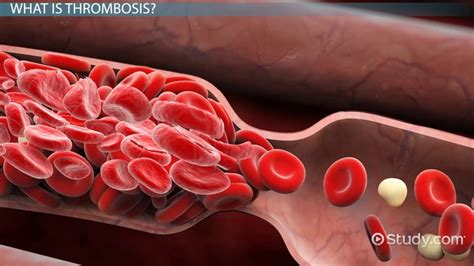 What Is Thrombosis? - Definition, Symptoms & Treatment - Lesson | Study.com