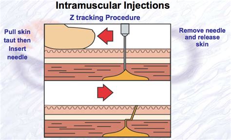 Z-tracking for IM injections | Nursing information, Nursing memes, Nursing students